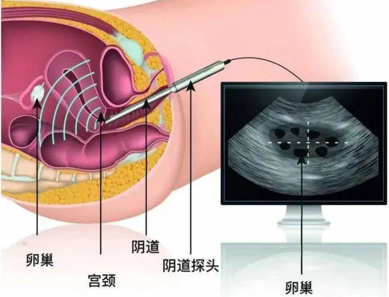 京广医院女性不孕症一站式生殖超声评估体系2.jpg
